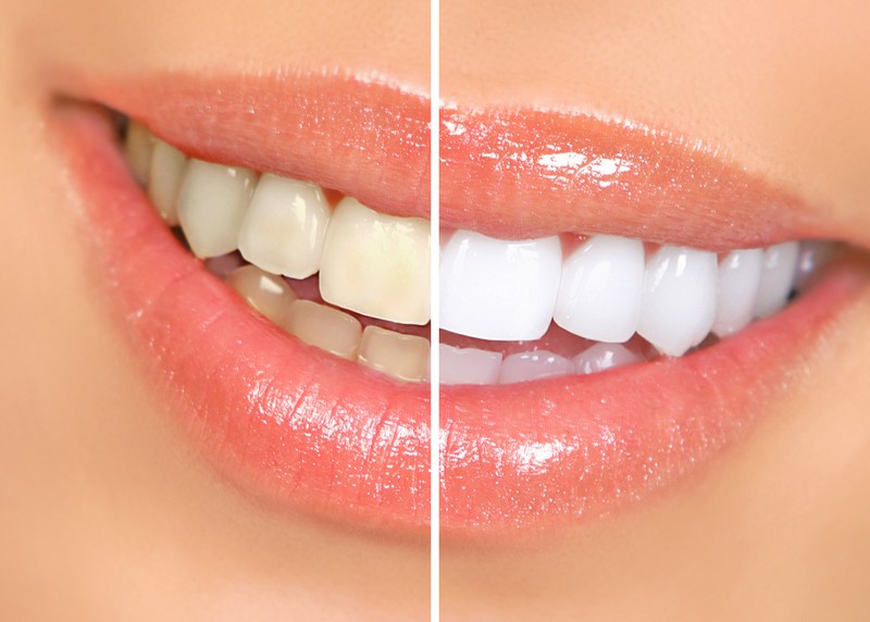 Teeth Whitening San Tan Valley, AZ